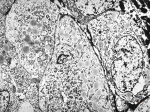 M,58y. | carcinoma gl. parotis